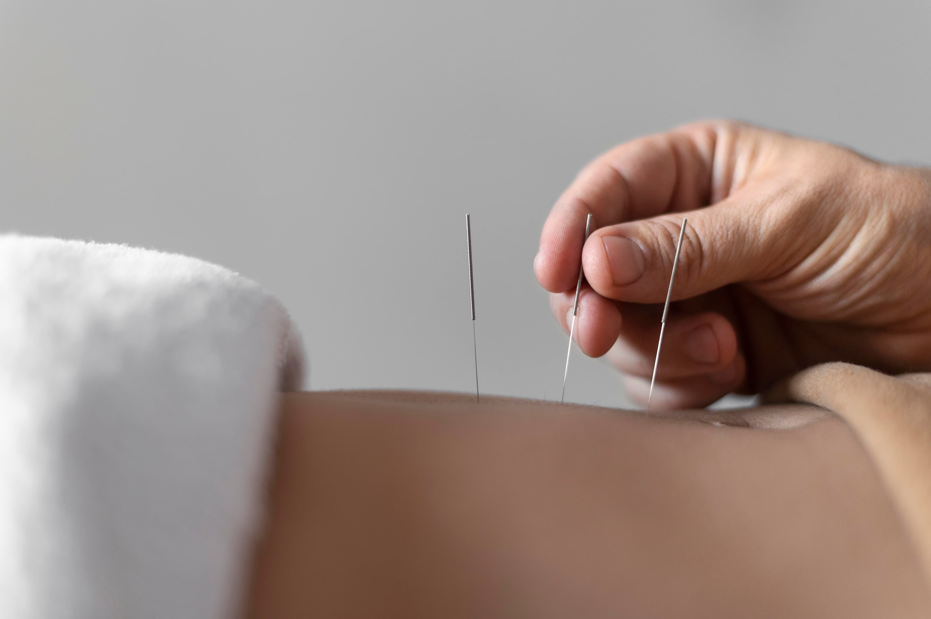 Bachelor Level in Acupuncture – Lateral Entry 2nd Year